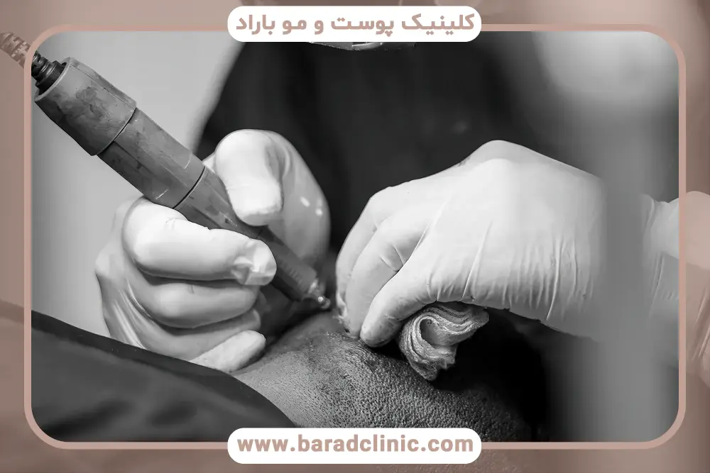 روش جدید کاشت مو با دستگاه