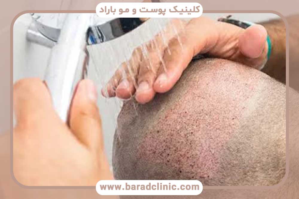 شستن بخیه سر بعد از کاشت ابرو