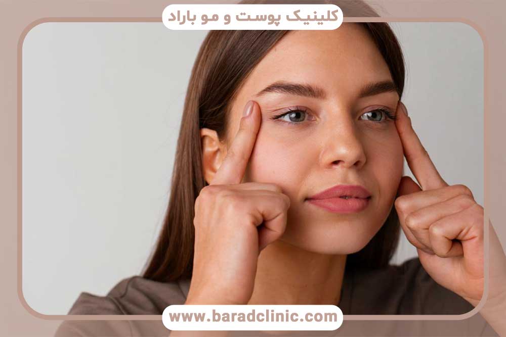 سوزش ابرو بعد از کاشت