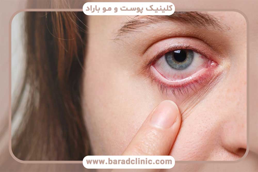 علت ورم بعد از کاشت ابرو