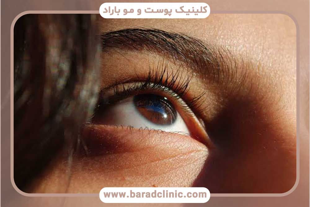 کاشت ابرو