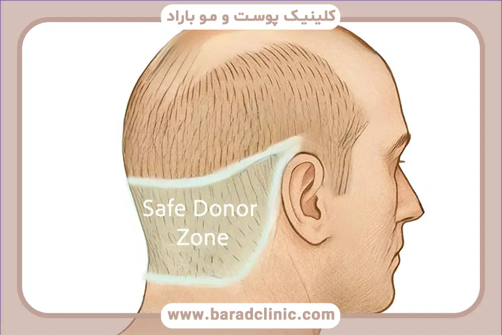 از کجا بفهمیم بانک موی خوبی داریم؟ بررسی تراکم