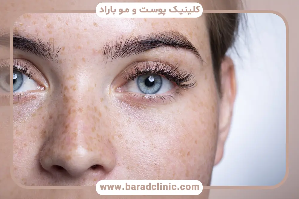 آیا عدم تقارن چشم بعد از بلفاروپلاستی طبیعی است؟