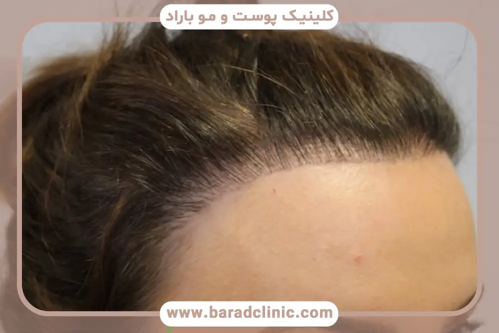 بررسی کاشت مو عروسکی 