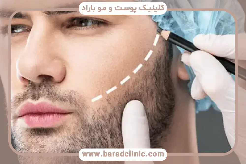 جای زخم کاشت ریش