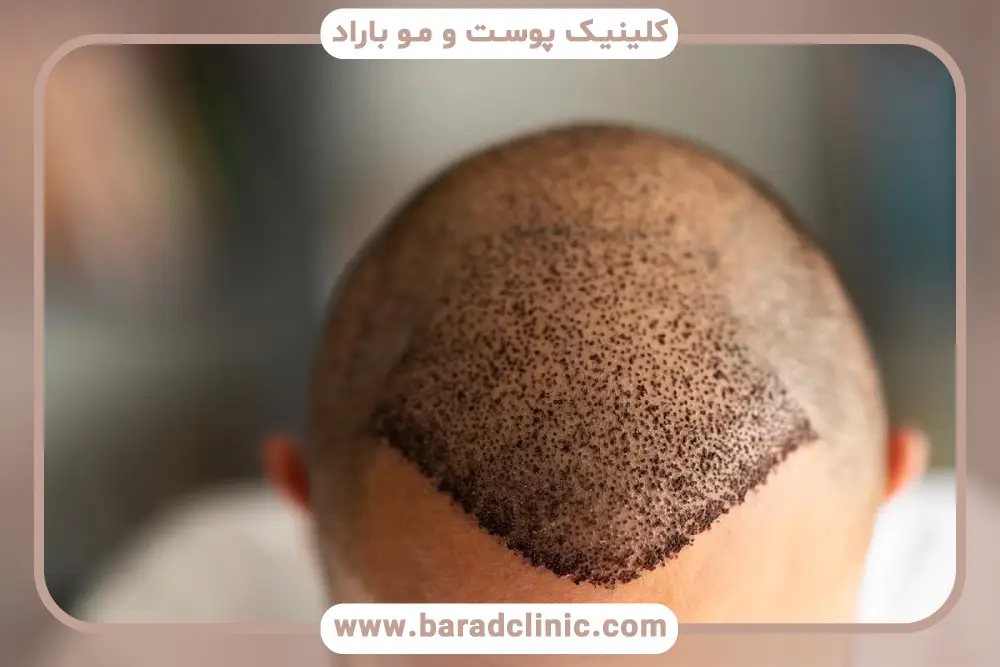بررسی ماندگاری کاشت مو 