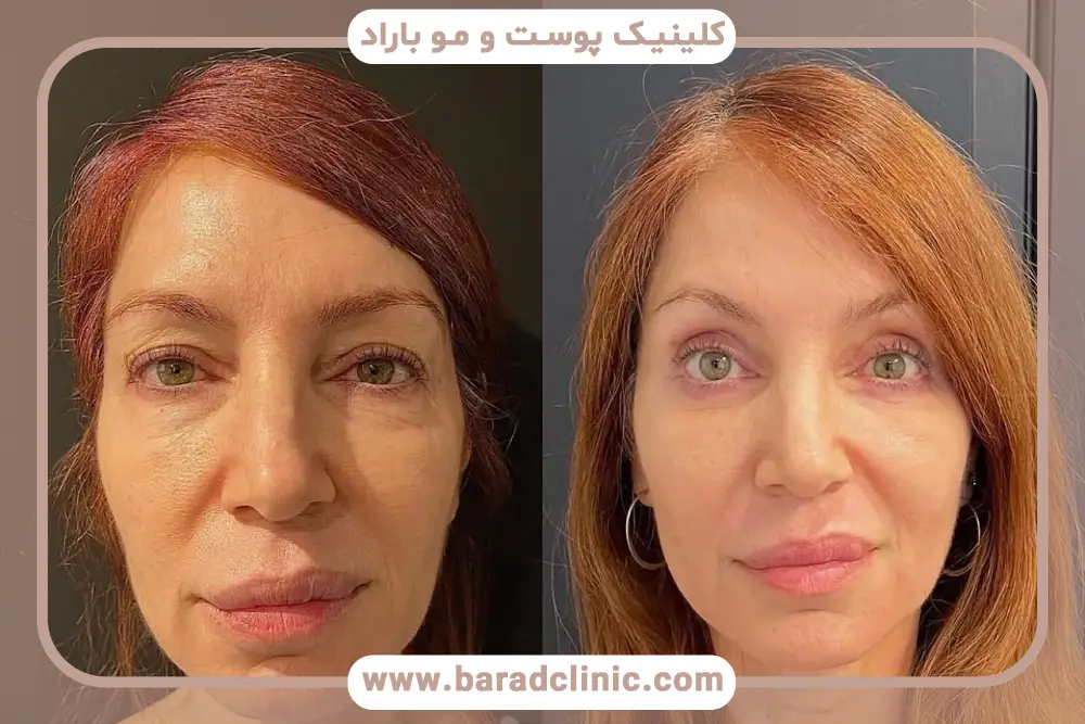 آشنایی با لیفت چشم