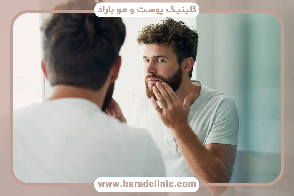 سن کاندیدای کاشت ریش 