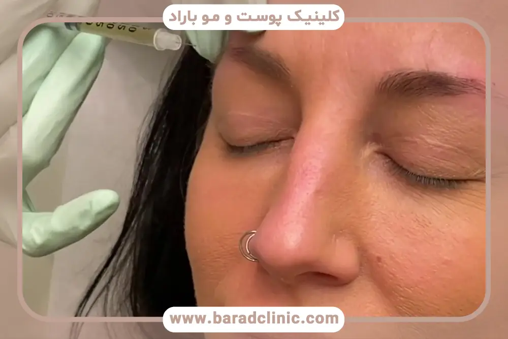 نحوه پی ار پی بعد از کاشت ابرو 