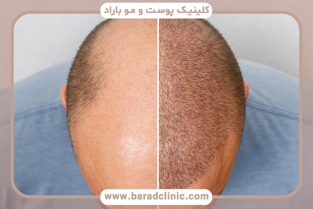آشنایی با کاشت مو قسطی با اسنپ پی 