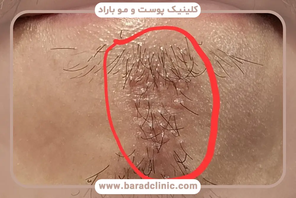 دلایل ایجاد جوش بعد از کاشت ریش