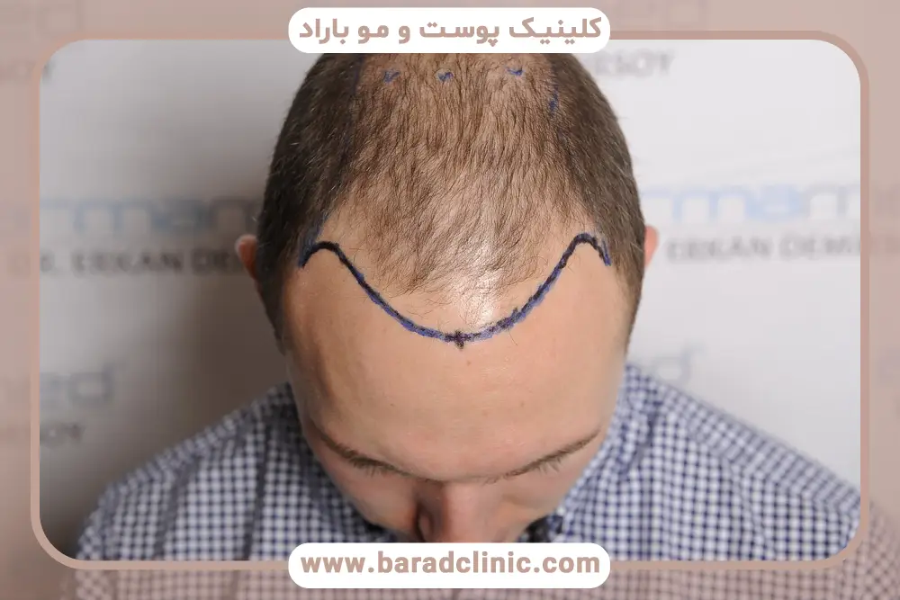 نسبت‌های طلایی در تعیین فاصله استاندارد خط رویش مو تا ابرو 