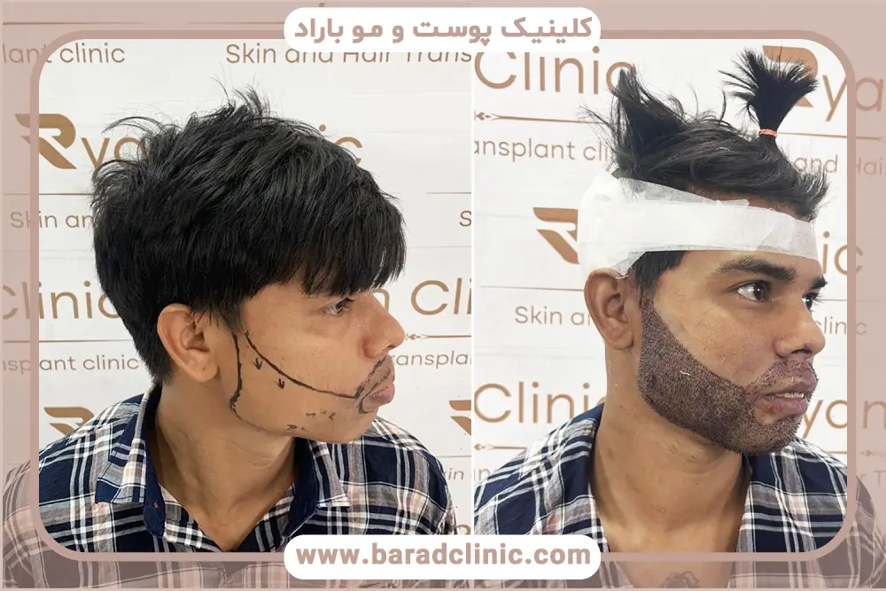 اهمیت طراحی خط ریش قبل از کاشت