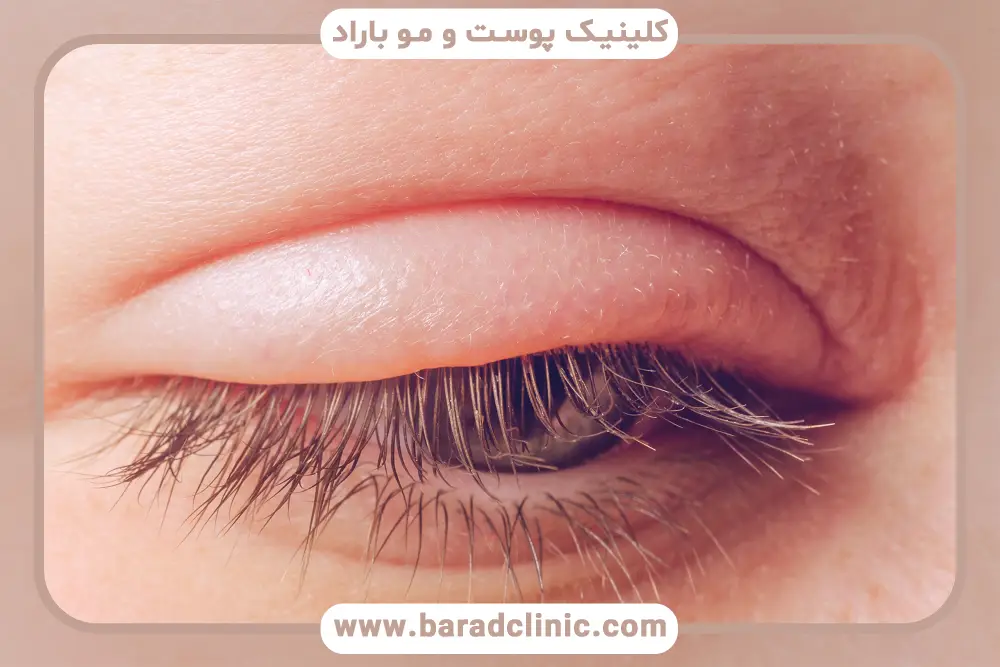 بلفاریت چشم یا التهاب پلک چیست؟