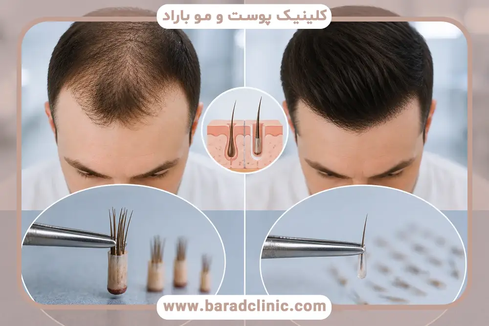 کاشت مو به روش AMT چیست؟