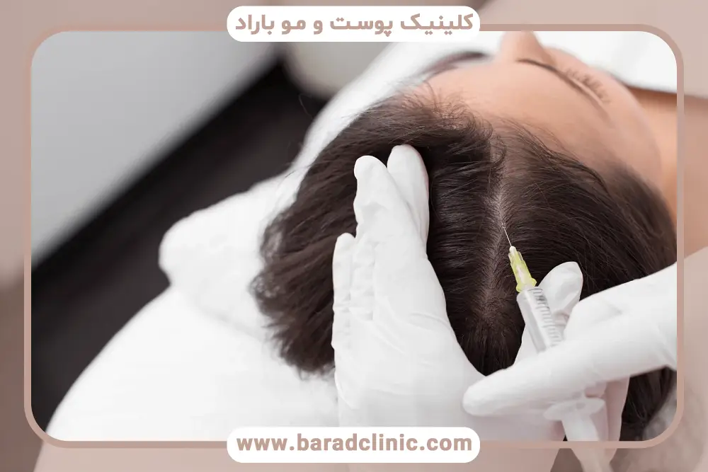 نحوه اثرگذاری کربوکسی تراپی بعد از کاشت مو 