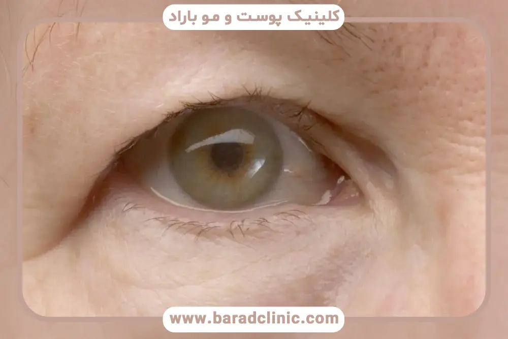 علائم افتادگی پلک یا پتوز 