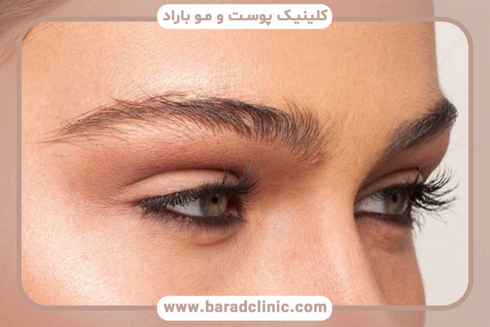 نتایج کاشت ابرو