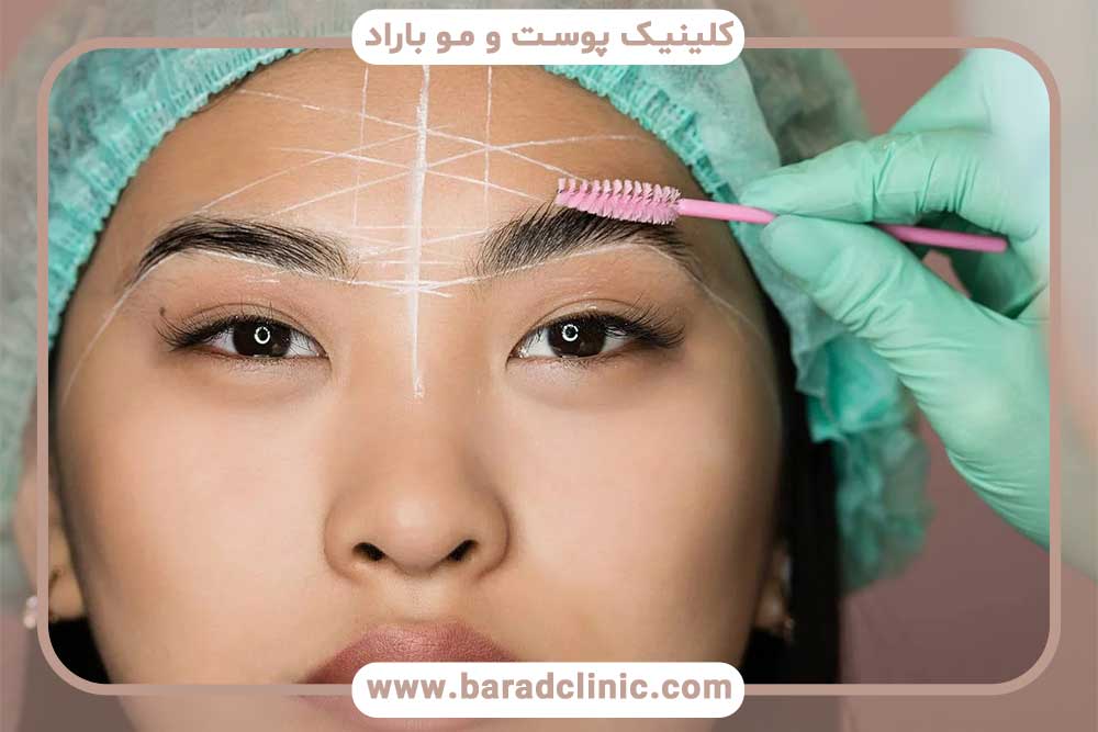 کاشت ابرو به روش نانوگرافت