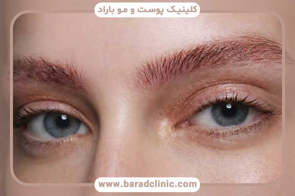 پوسته پوسته شدن ابرو بعد از کاشت