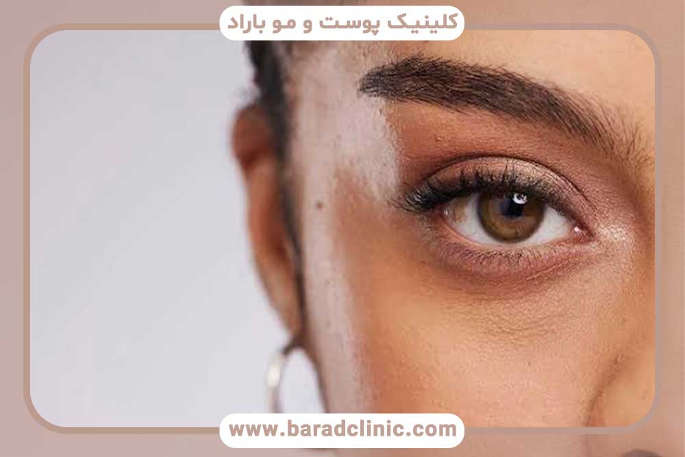 نتایج کاشت ابرو