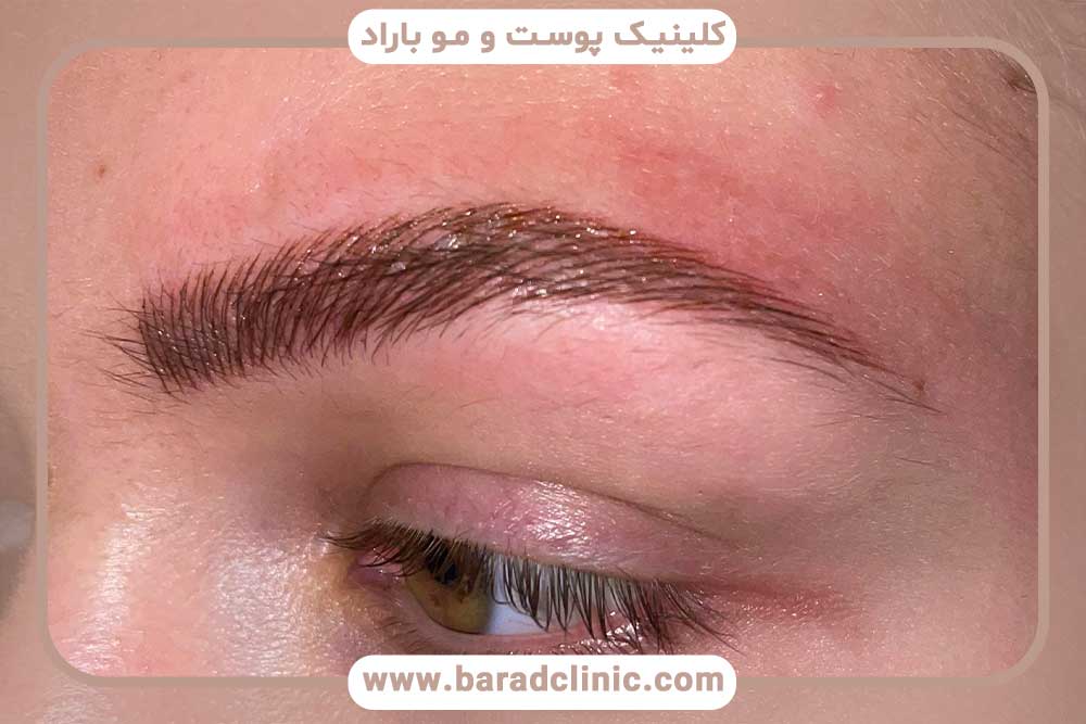 درمان سوزش ابرو بعد از کاشت