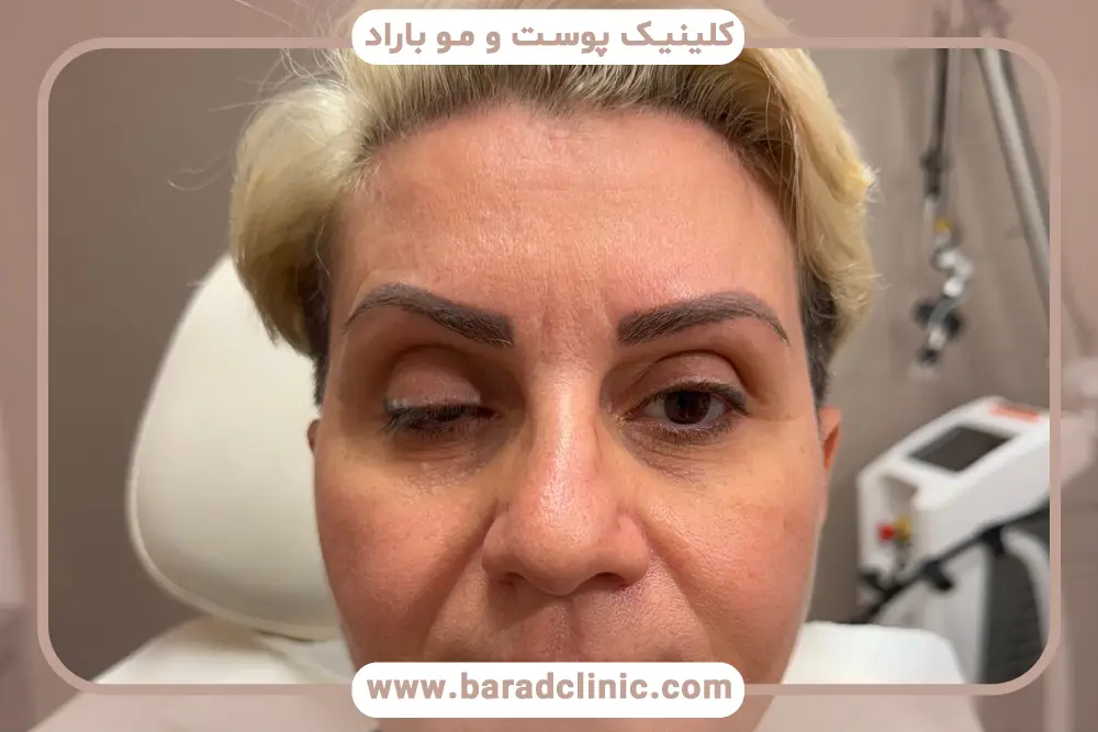 بررسی علائم در تصاویر افتادگی پلک بعد از تزریق بوتاکس