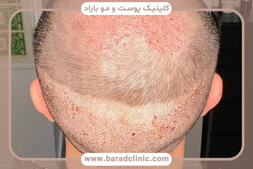 بررسی بهترین روش کاشت مو برای افراد با بانک موی ضعیف 