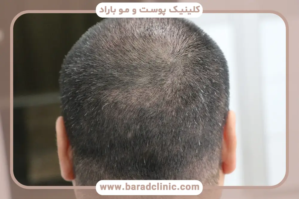 از کجا بفهمیم بانک موی خوبی داریم؟ سلامت پوست سر