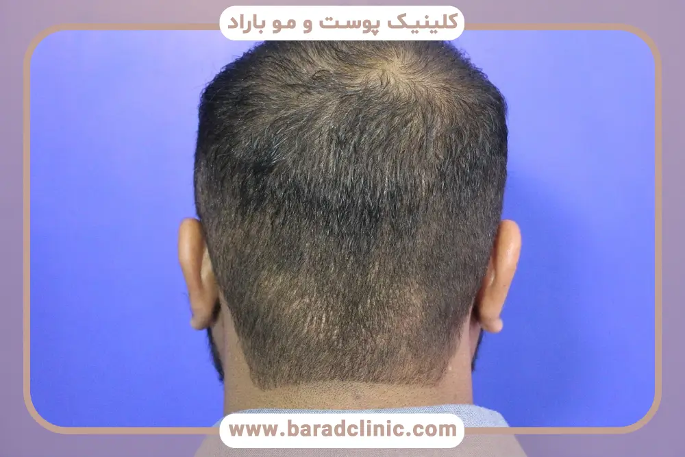 تقویت بانک مو قبل از کاشت با تغذیه مناسب