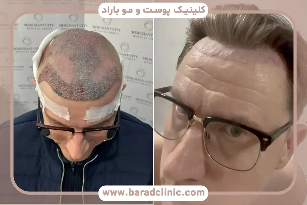 نقش طراحی خط رویش در کاشت مو عروسکی 
