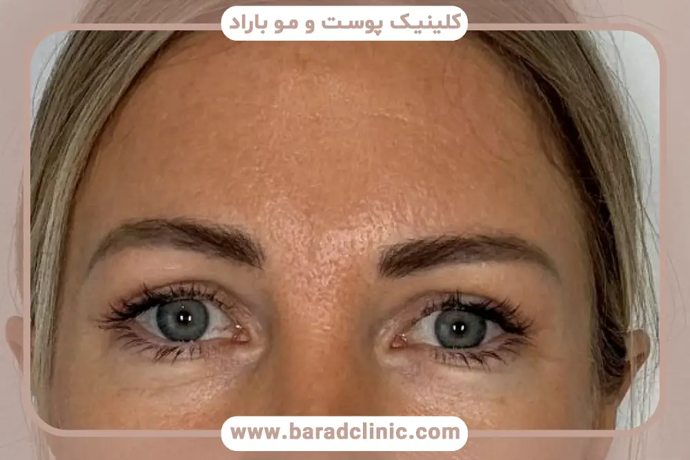 انحراف چشم بعد از بلفاروپلاستی موقت و دائمی