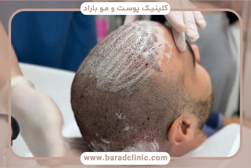 شسشوی سر بعد از کاشت مو
