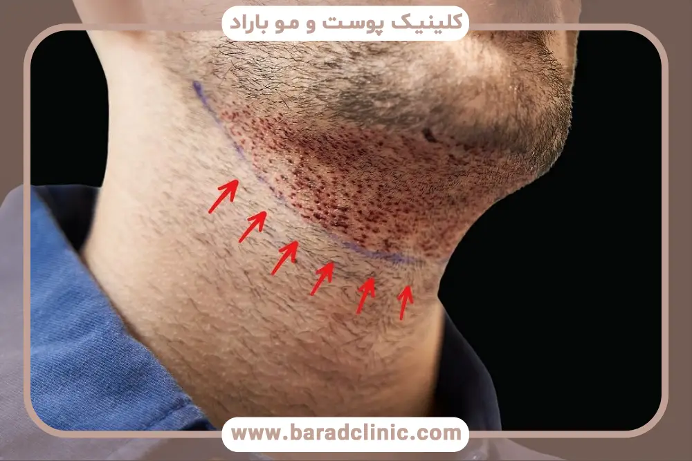انواع جای زخم کاشت ریش