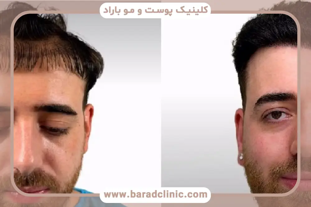 عوامل موثر بر ماندگاری کاشت مو 
