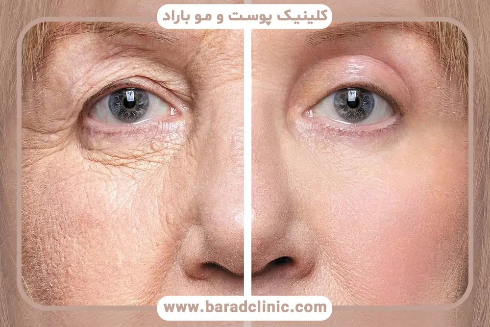 تفاوت بلفاروپلاستی و لیفت چشم از نظر کاربرد