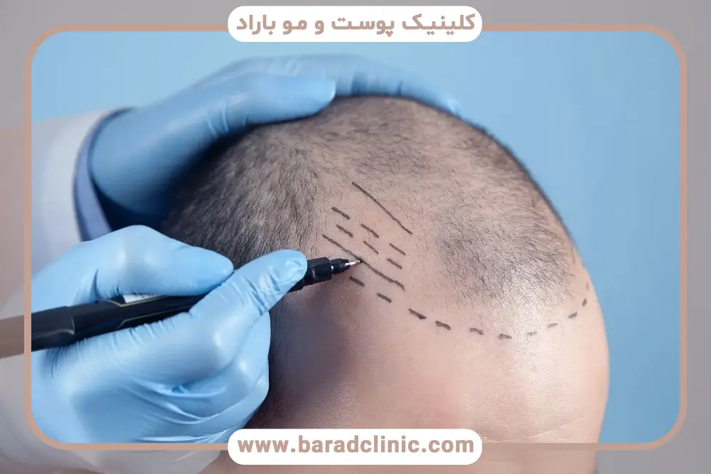 بررسی‌های پزشکی کاشت مو در بیماران ام اس 