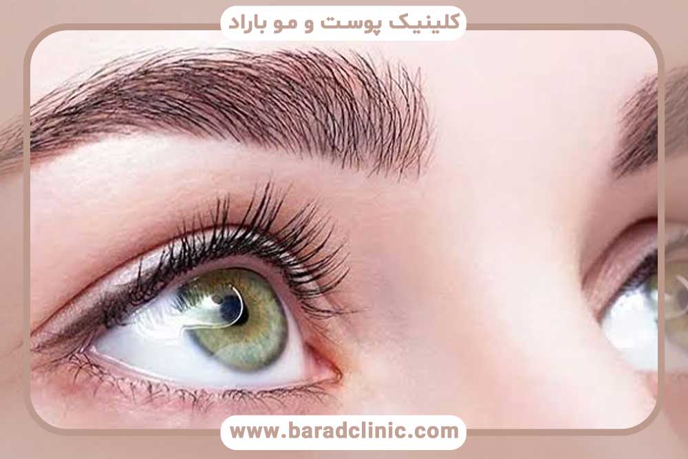 کاشت ابرو