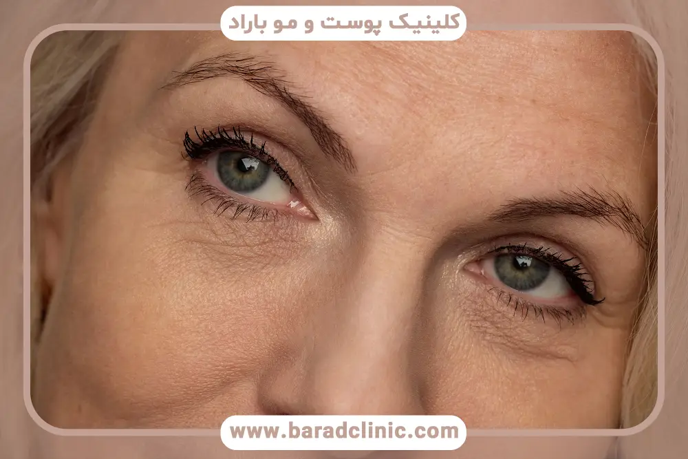 تشخیص علت افتادگی پلک