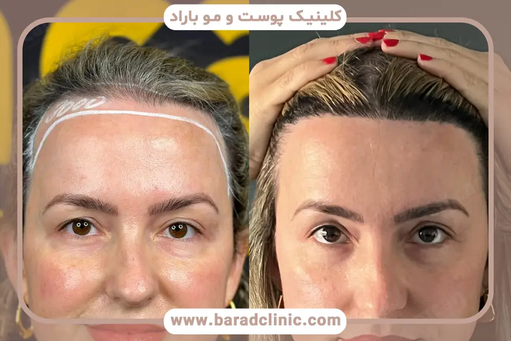 بررسی شرایط کاشت مو در زنان