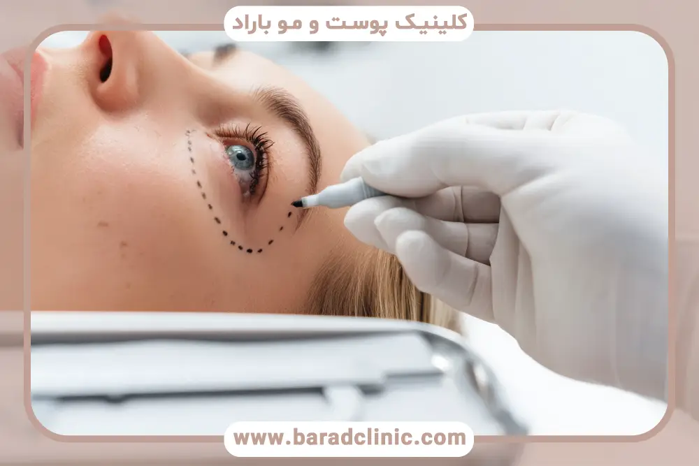 عفونت محل جراحی از عوارض جراحی بلفاروپلاستی