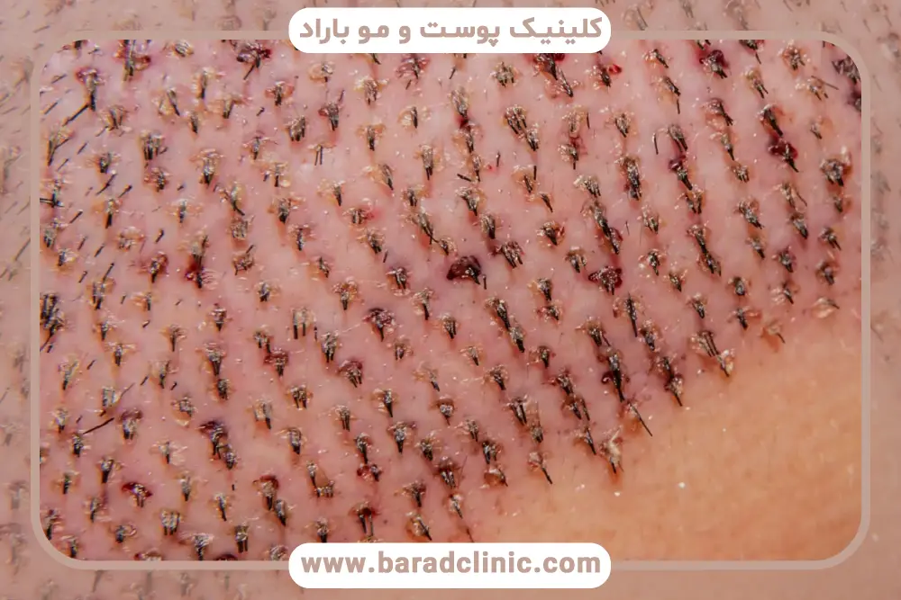 تفاوت جوش بعد از کاشت ریش با عفونت