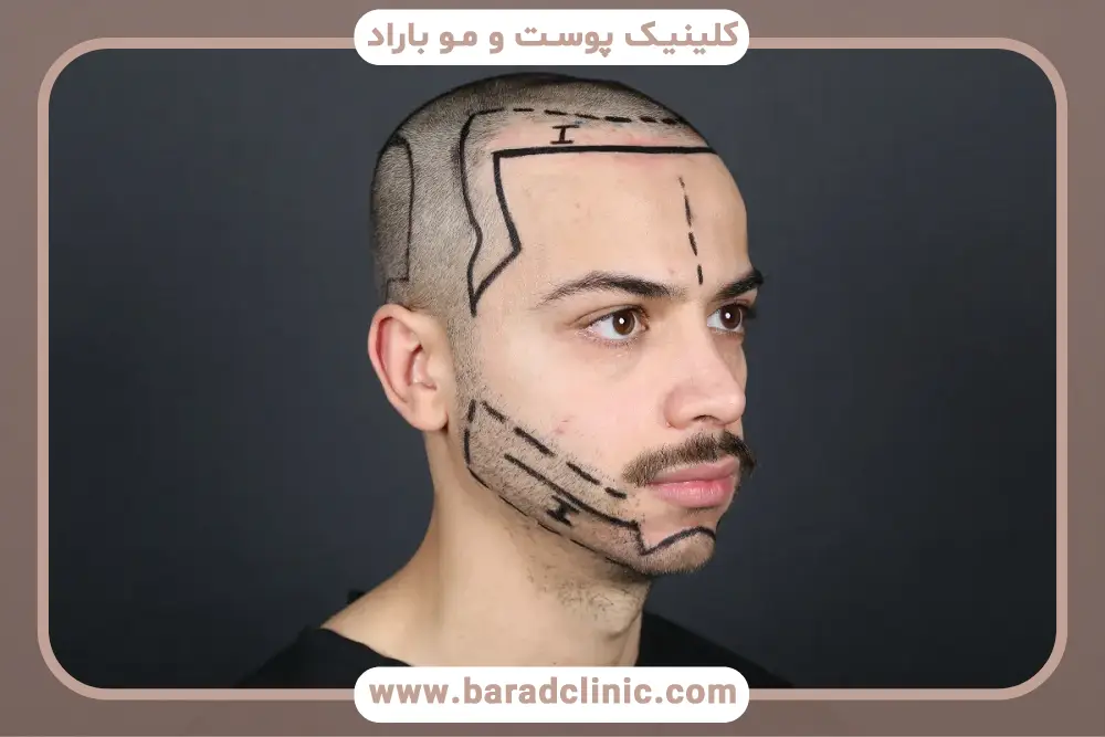 اصول طراحی خط ریش قبل از کاشت