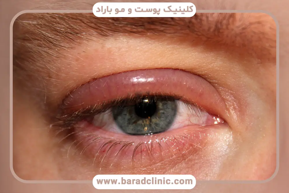 دلایل ایجاد بلفاریت چشم یا التهاب پلک