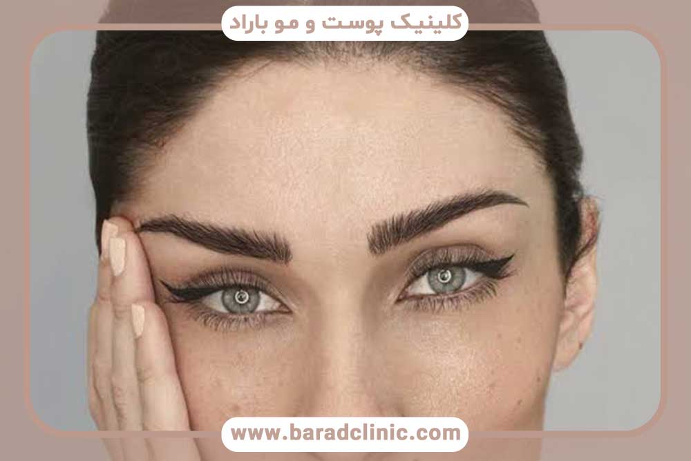 کاشت ابرو تهران