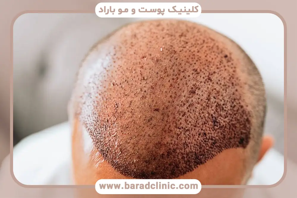 طراحی خط رویش در کاشت مو به روش AMT