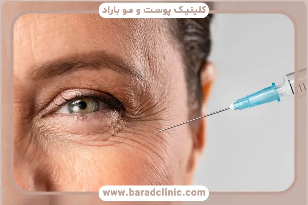کاهش خطوط پنجه کلاغی از فواید بوتاکس صورت 