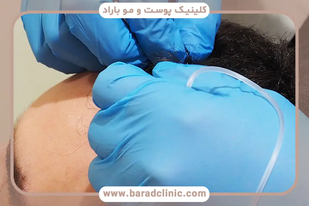 بهترین زمان کربوکسی تراپی بعد از کاشت مو 