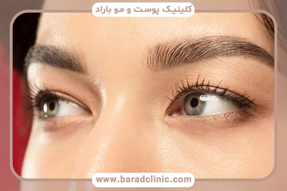 عوامل موثر بر نتایج کاشت ابرو