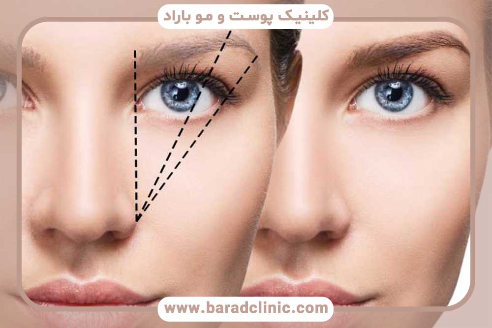 مراقبت‌های کاشت ابرو